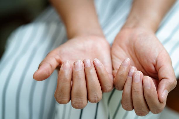 brittle damaged nails after using shellac or gel lacquer